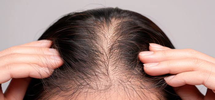 Alopecia na mulher: quando a queda de cabelo merece atenção