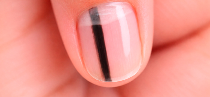 Riscas escuras nas unhas: quando são normais e quando devem ser avaliadas?